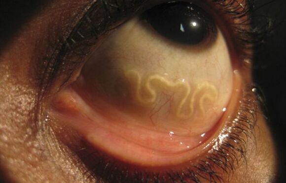 Loa Loa worm lives in the human eye and causes blindness